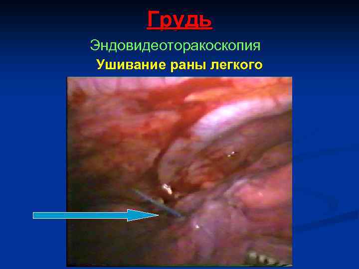 Грудь Эндовидеоторакоскопия Ушивание раны легкого 