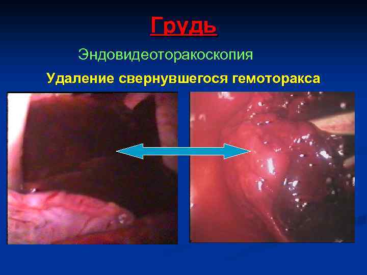 Грудь Эндовидеоторакоскопия Удаление свернувшегося гемоторакса 