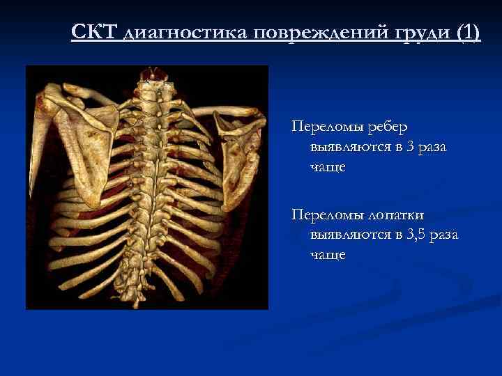 СКТ диагностика повреждений груди (1) Переломы ребер выявляются в 3 раза чаще Переломы лопатки