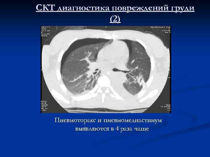 СКТ диагностика повреждений груди (2 ) Пневмоторакс и пневмомедиастинум выявляются в 4 раза чаще