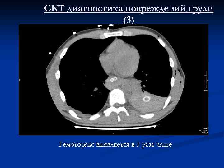 СКТ диагностика повреждений груди (3) Гемоторакс выявляется в 3 раза чаще 