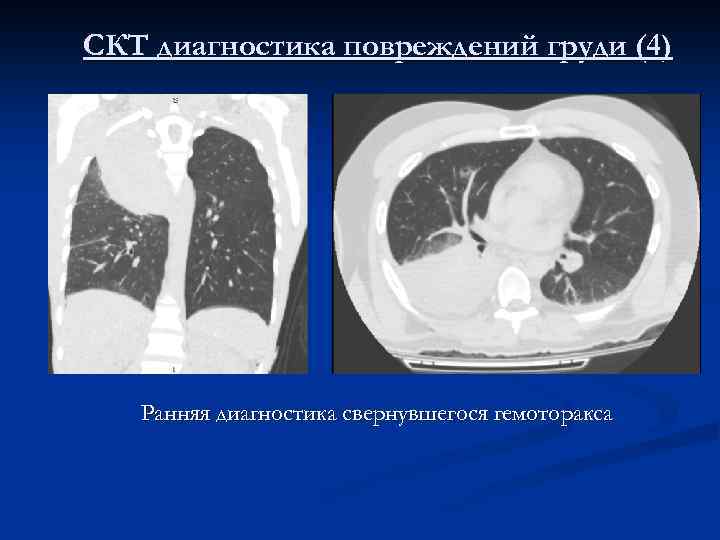 СКТ диагностика повреждений груди (4) Ранняя диагностика свернувшегося гемоторакса 