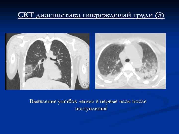 СКТ диагностика повреждений груди (5) Выявление ушибов легких в первые часы после поступления! 