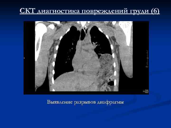 СКТ диагностика повреждений груди (6) Выявление разрывов диафрагмы 