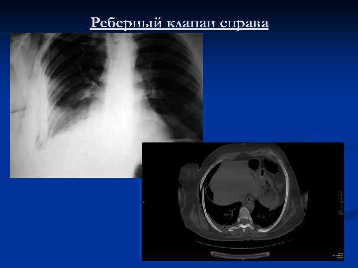 Реберный клапан справа 