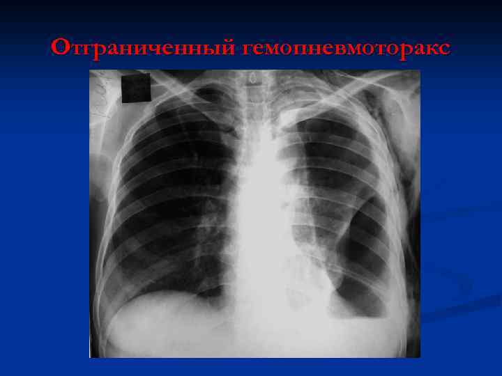 Отграниченный гемопневмоторакс 