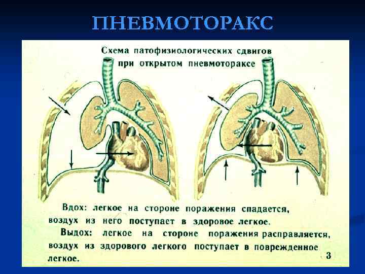 Пневмоторакс это