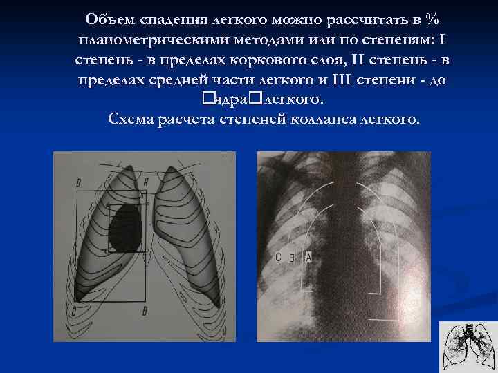 Объем спадения легкого можно рассчитать в % планометрическими методами или по степеням: I степень