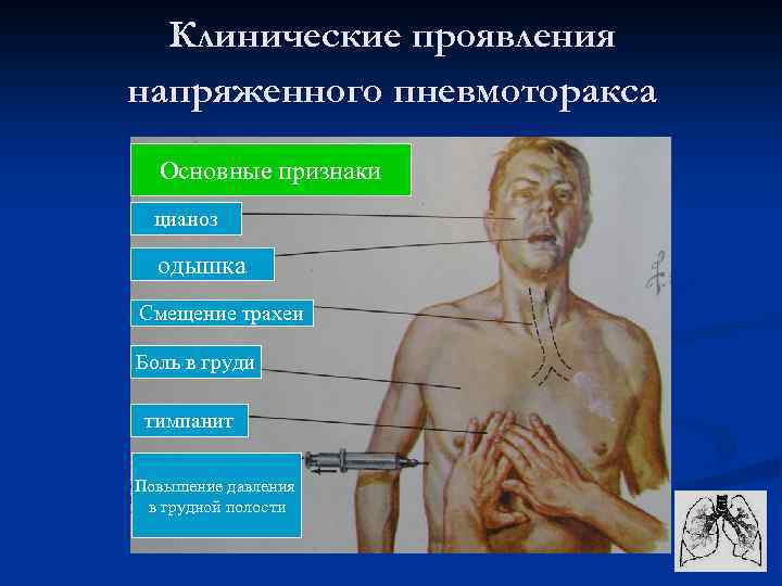 Клинические проявления напряженного пневмоторакса Основные признаки цианоз одышка Смещение трахеи Боль в груди тимпанит