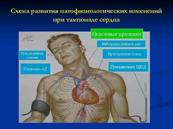 Схема развития патофизиологических изменений при тампонаде сердца Основные признаки Набухание шейных вен Шок различной