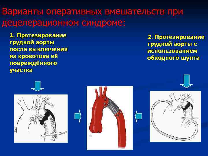 Варианты оперативных вмешательств при децелерационном синдроме: 1. Протезирование грудной аорты после выключения из кровотока