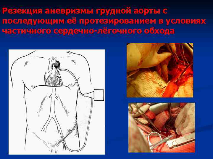 Резекция аневризмы грудной аорты с последующим её протезированием в условиях частичного сердечно-лёгочного обхода 