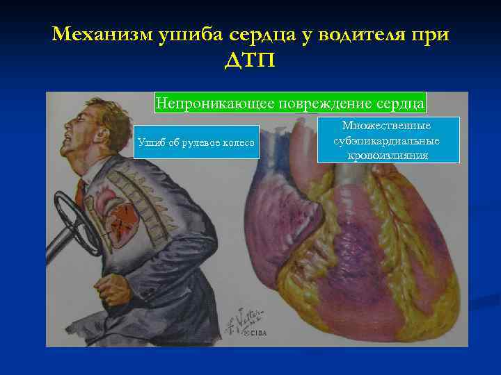 Механизм ушиба сердца у водителя при ДТП Непроникающее повреждение сердца Ушиб об рулевое колесо