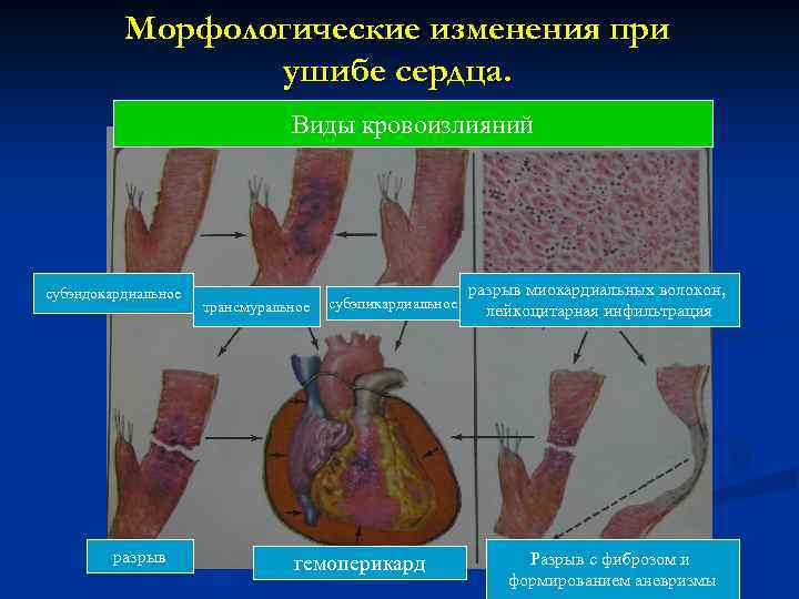 Морфологические изменения при ушибе сердца. Виды кровоизлияний субэндокардиальное разрыв трансмуральное субэпикардиальное гемоперикард разрыв миокардиальных