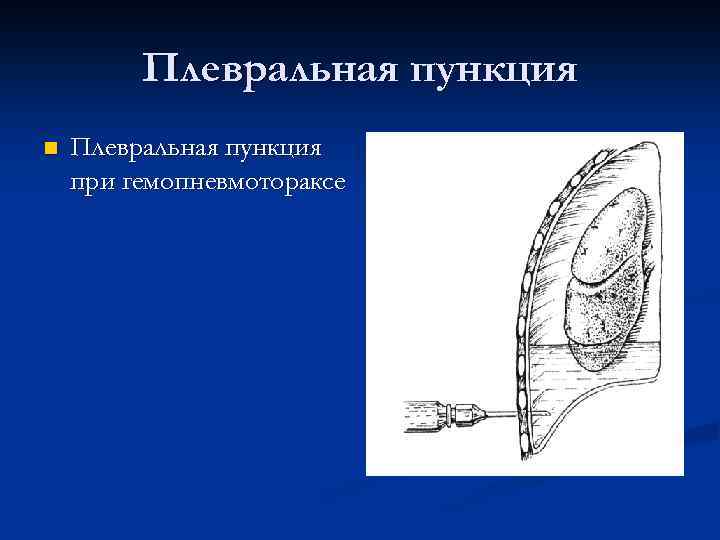 Плевральная пункция n Плевральная пункция при гемопневмотораксе 