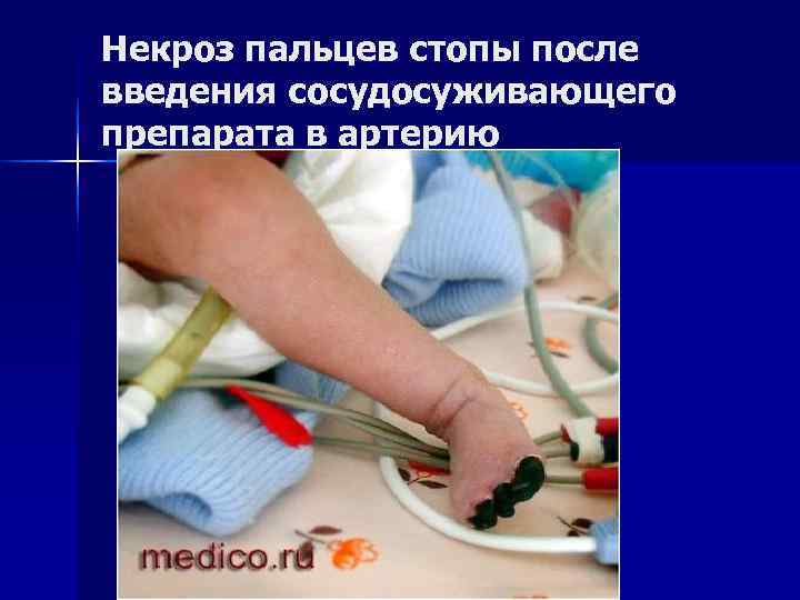 Некроз пальцев стопы после введения сосудосуживающего препарата в артерию 