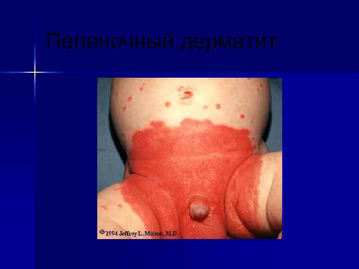 Пеленочный дерматит 