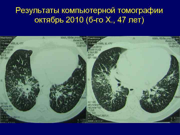 Описание кт легких фото