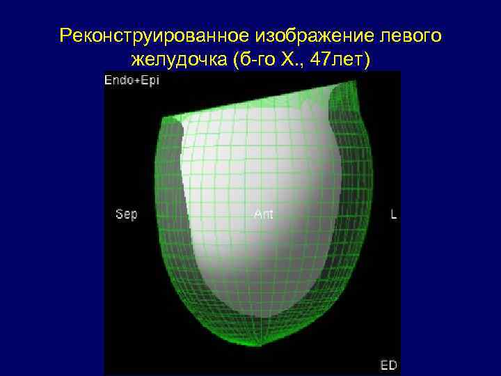 Реконструированное изображение левого желудочка (б-го Х. , 47 лет) Реконструированное изображение левого желудочка (б-го Х. , 47 лет)