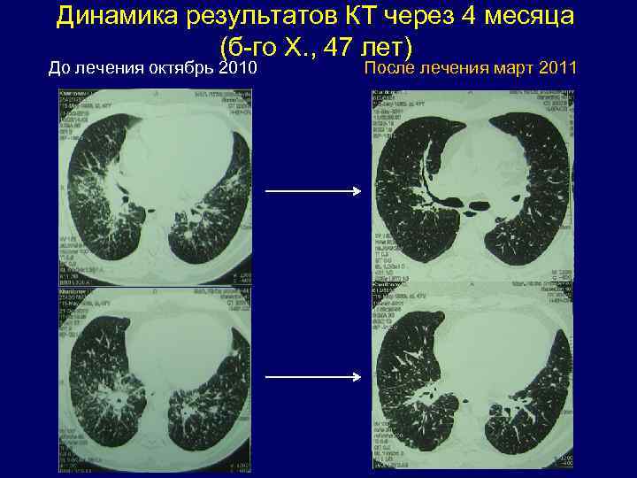Динамика результатов КТ через 4 месяца (б-го Х. , 47 лет) До лечения Динамика результатов КТ через 4 месяца (б-го Х. , 47 лет) До лечения