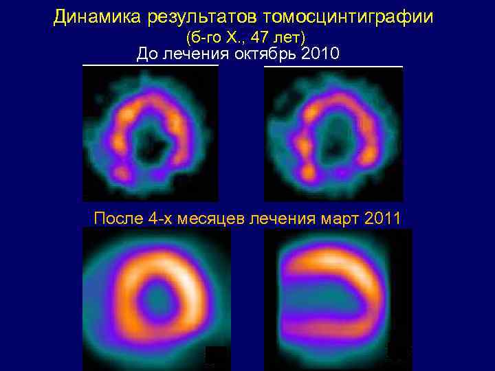 Динамика результатов томосцинтиграфии (б-го Х. , 47 лет) До лечения Динамика результатов томосцинтиграфии (б-го Х. , 47 лет) До лечения