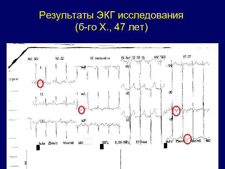 Результаты экг