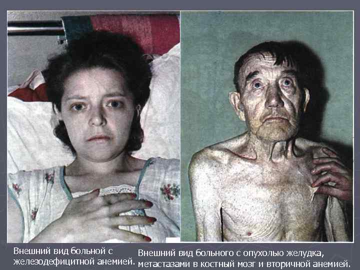 Внешний вид больной с Внешний вид больного с опухолью желудка, железодефицитной анемией. метастазами в