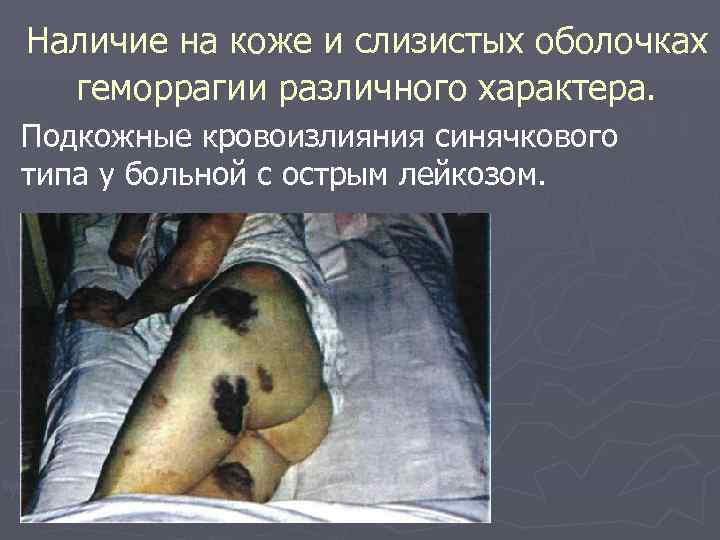Наличие на коже и слизистых оболочках  геморрагии различного характера. Подкожные кровоизлияния синячкового типа