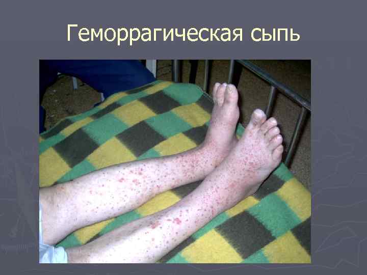 Геморрагическая сыпь 