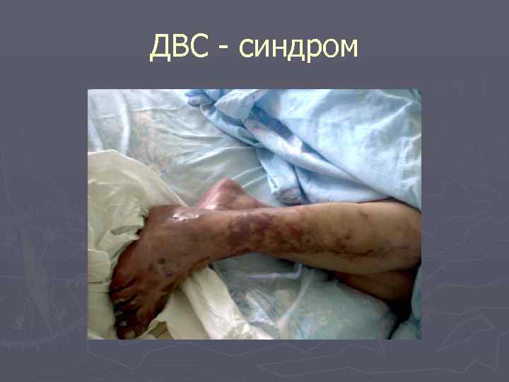 ДВС - синдром 