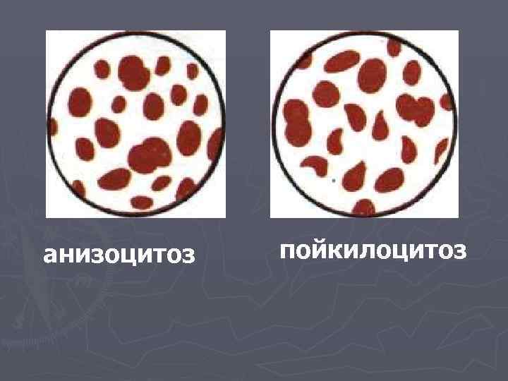 анизоцитоз  пойкилоцитоз 