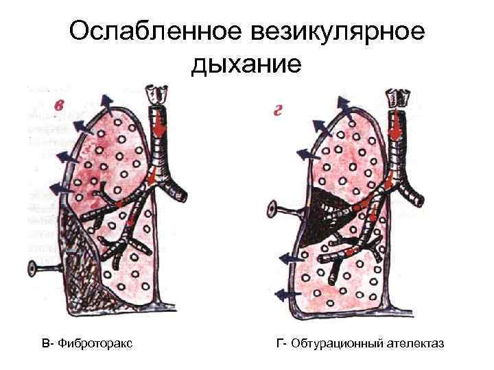 Виды дыхания при аускультации легких схема