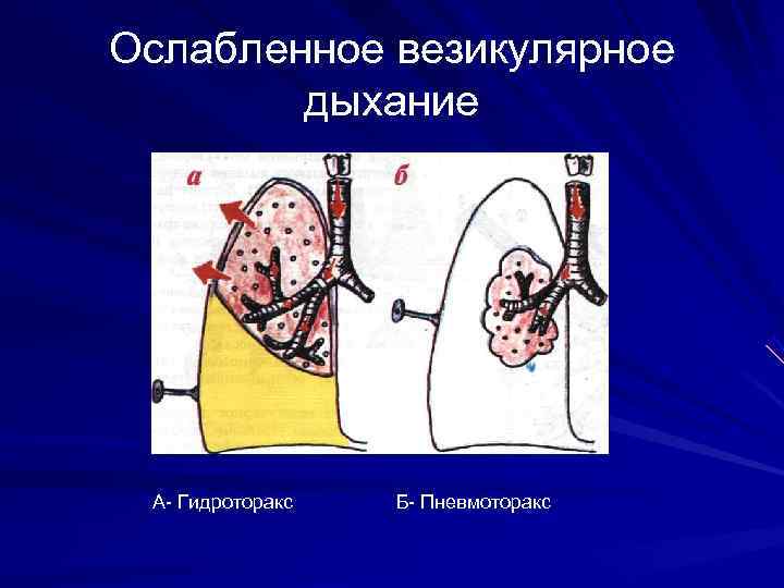 Ослабленное везикулярное   дыхание А Гидроторакс  Б Пневмоторакс 