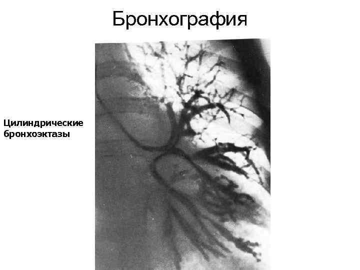 Бронхография Цилиндрические бронхоэктазы Бронхография Цилиндрические бронхоэктазы