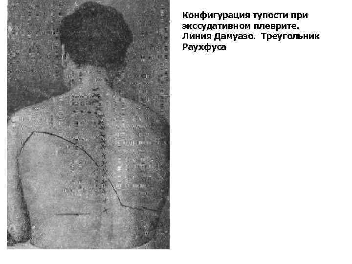 Конфигурация тупости при экссудативном плеврите. Линия Дамуазо. Треугольник Раухфуса Конфигурация тупости при экссудативном плеврите. Линия Дамуазо. Треугольник Раухфуса