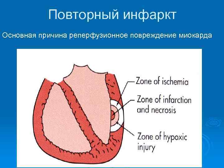 Повторный инфаркт Основная причина реперфузионное повреждение миокарда 