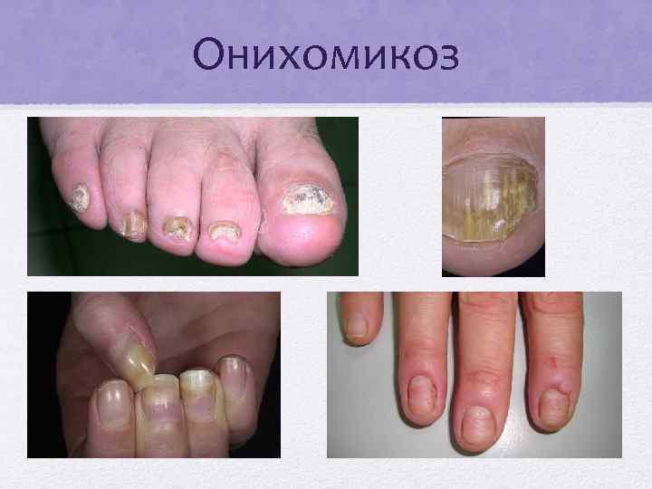 Онихомикоз 