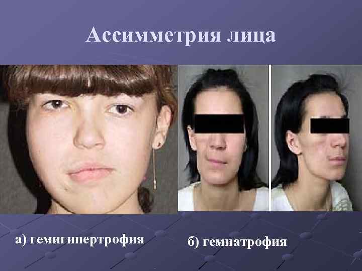 Ассимметрия лица а) гемигипертрофия б) гемиатрофия Ассимметрия лица а) гемигипертрофия б) гемиатрофия