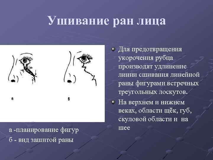 Ушивание ран лица Для предотвращения Ушивание ран лица Для предотвращения