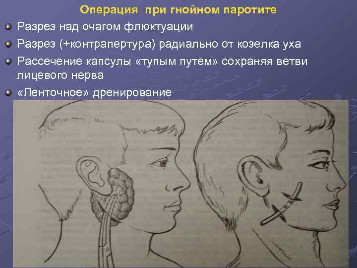 Операция при гнойном паротите Разрез над очагом флюктуации Разрез (+контрапертура) радиально от Операция при гнойном паротите Разрез над очагом флюктуации Разрез (+контрапертура) радиально от