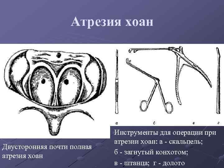 Атрезия это. Двусторонняя атрезия Хоан врожденная. Неполная атрезия Хоан симптомы.