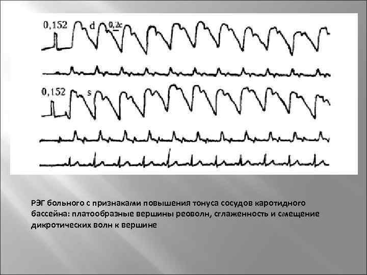 РЭГ больного с признаками повышения тонуса сосудов каротидного бассейна: платообразные вершины реоволн, сглаженность и