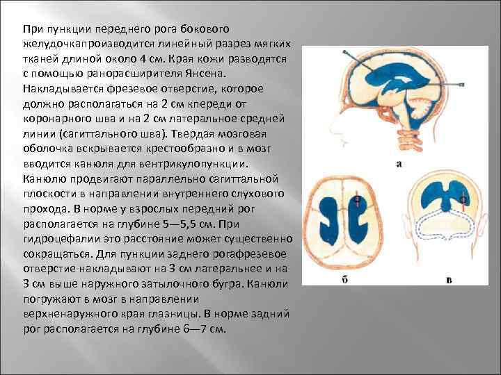 При пункции переднего рога бокового желудочкапроизводится линейный разрез мягких тканей длиной около 4 см.