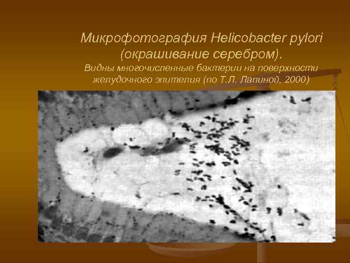 Микрофотография Helicobacter pylori (окрашивание серебром). Видны многочисленные бактерии на поверхности желудочного эпителия (по Т.