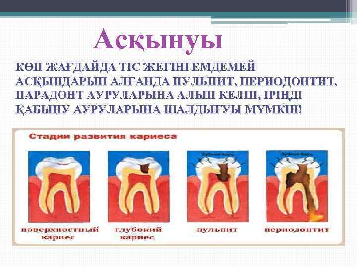    Асқынуы КӨП ЖАҒДАЙДА ТІС ЖЕГІНІ ЕМДЕМЕЙ АСҚЫНДАРЫП АЛҒАНДА ПУЛЬПИТ, ПЕРИОДОНТИТ, ПАРАДОНТ