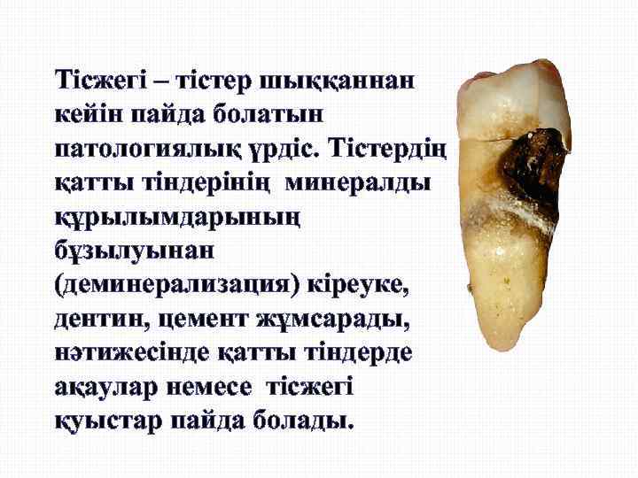 Тісжегі – тістер шыққаннан кейін пайда болатын патологиялық үрдіс. Тістердің қатты тіндерінің минералды құрылымдарының