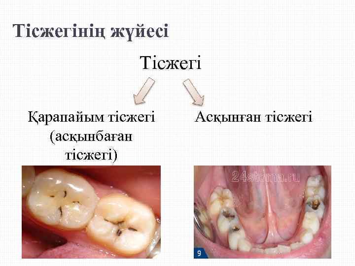 Тісжегінің жүйесі    Тісжегі  Қарапайым тісжегі  Асқынған тісжегі (асқынбаған 