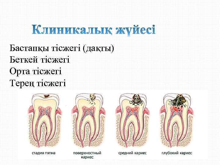 Бастапқы тісжегі (дақты) Беткей тісжегі Орта тісжегі Терең тісжегі 