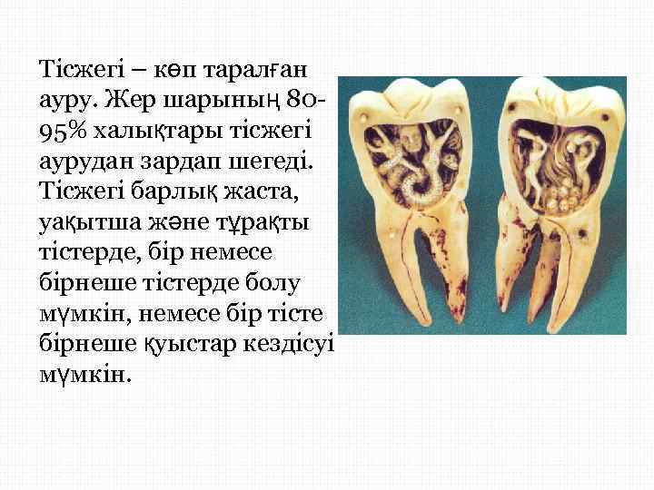 Тісжегі – көп таралған ауру. Жер шарының 80 - 95% халықтары тісжегі аурудан зардап