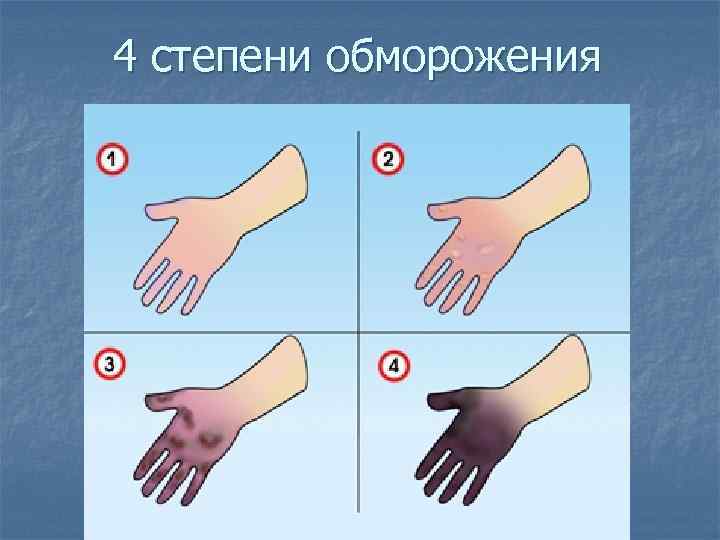 4 степени обморожения 